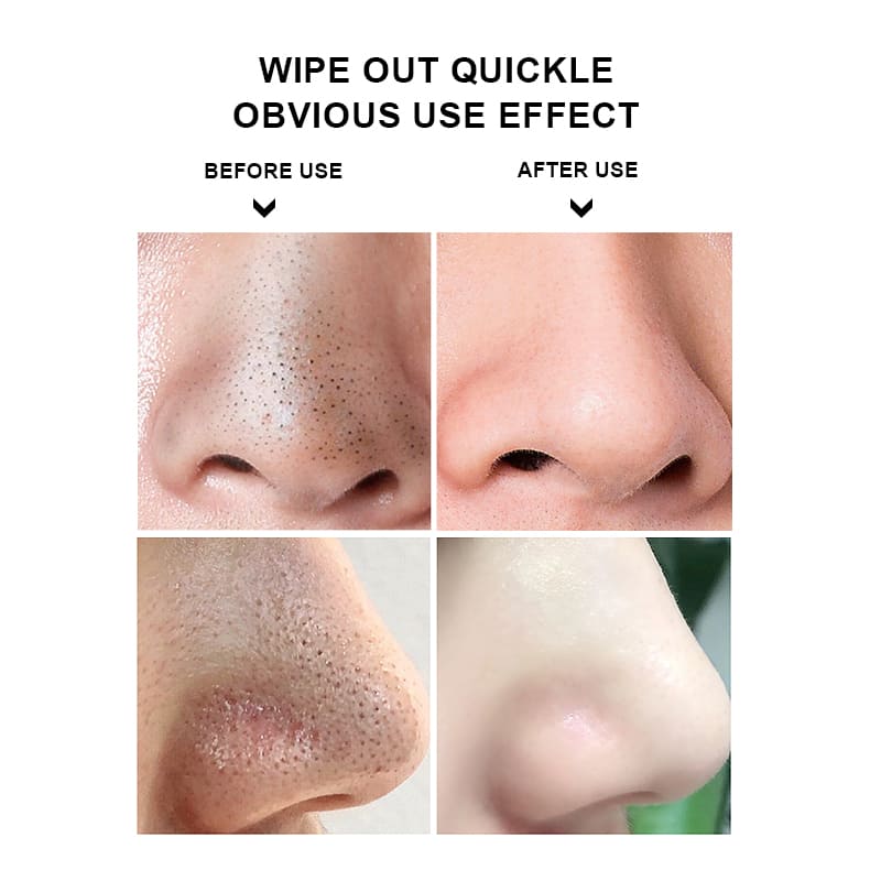 10 Deep Blackhead Removal-Removing Kit with Tea Tree Oil
