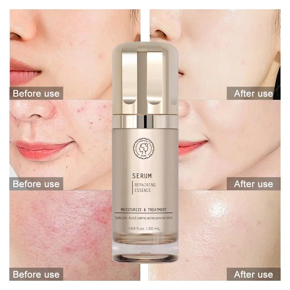 Salicylic Acid Acne Serum,Skincare Manufacturer In China Salicylic Acid Acne Serum,Skincare Manufacturer In China
