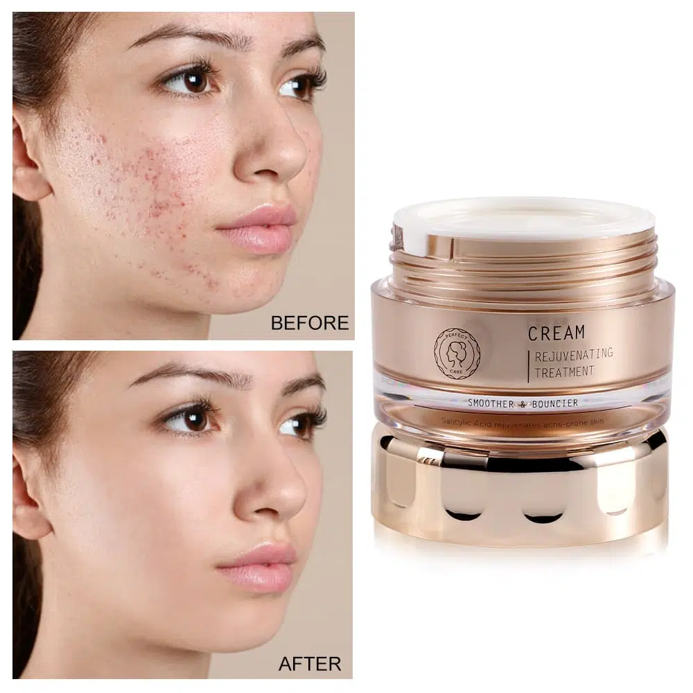 Salicylic Acid Acne Cream,Facial Care Private Label In China Salicylic Acid Acne Cream,Facial Care Private Label In China